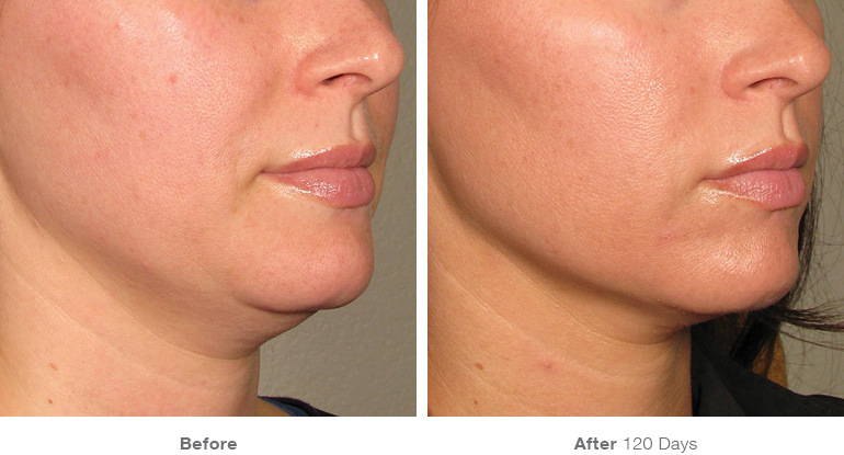 Before and After Ultherapy Neck Lift in Santa Monica and Brentwood