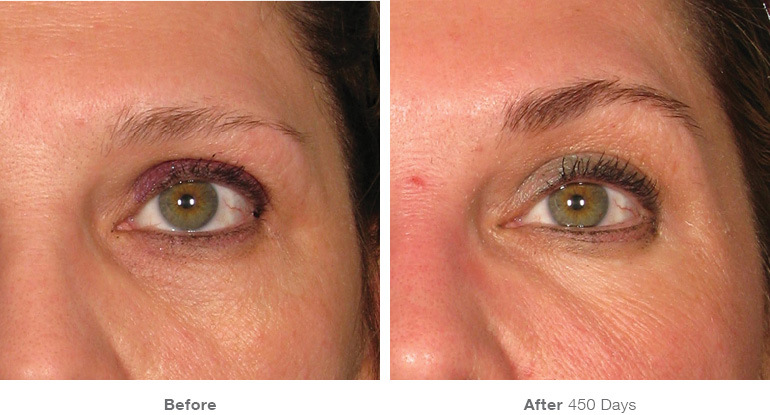 Ultherapy Medical Spa in Santa Monica and Brentwood 90049